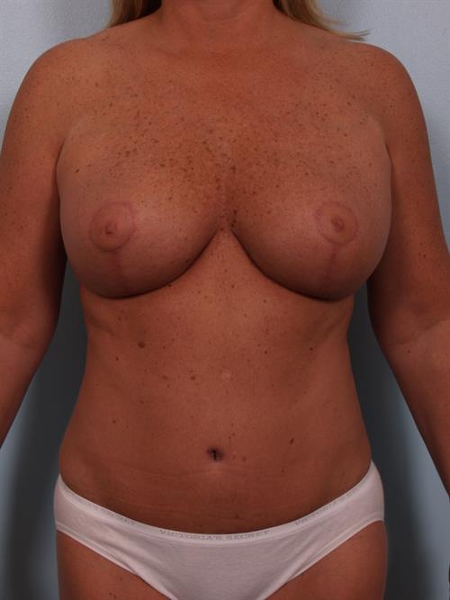 Tummy Tuck After Photo | Phoenix and Scottsdale, AZ | Scottsdale Center for Plastic Surgery