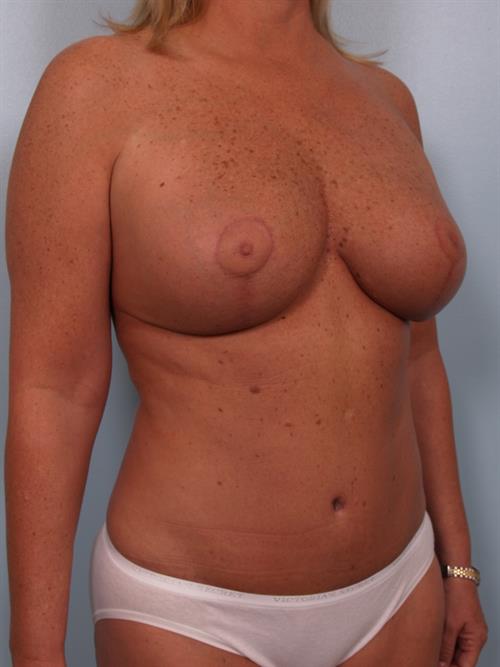 Tummy Tuck After Photo | Phoenix and Scottsdale, AZ | Scottsdale Center for Plastic Surgery