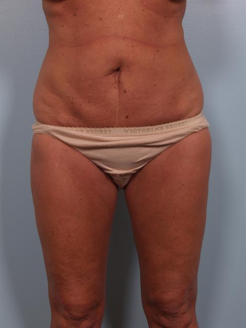 Tummy Tuck Before Photo | Phoenix and Scottsdale, AZ | Scottsdale Center for Plastic Surgery
