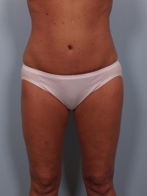 Tummy Tuck After Photo | Phoenix and Scottsdale, AZ | Scottsdale Center for Plastic Surgery