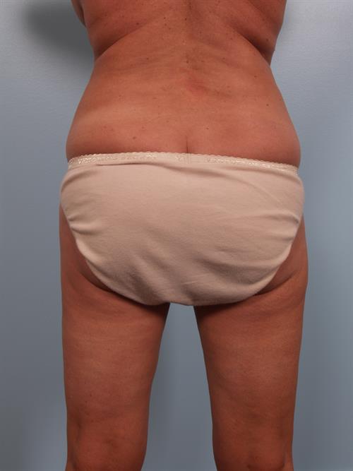 Tummy Tuck Before Photo | Phoenix and Scottsdale, AZ | Scottsdale Center for Plastic Surgery