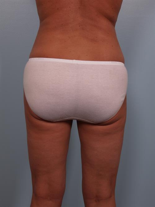 Tummy Tuck After Photo | Phoenix and Scottsdale, AZ | Scottsdale Center for Plastic Surgery