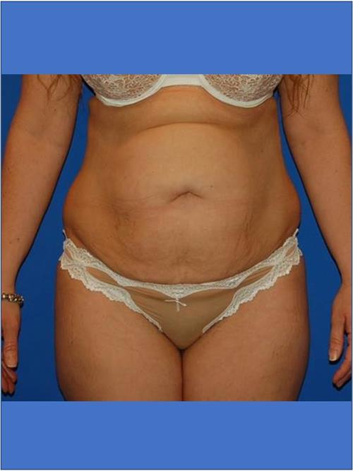 Tummy Tuck Before Photo | Phoenix and Scottsdale, AZ | Scottsdale Center for Plastic Surgery