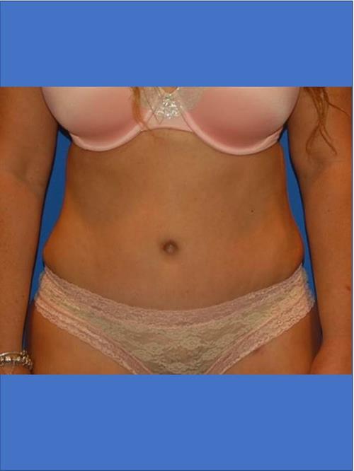 Tummy Tuck After Photo | Phoenix and Scottsdale, AZ | Scottsdale Center for Plastic Surgery