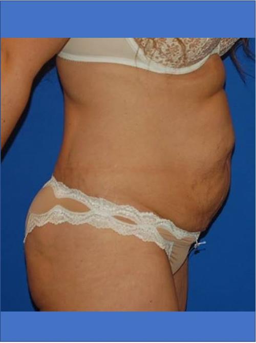 Tummy Tuck Before Photo | Phoenix and Scottsdale, AZ | Scottsdale Center for Plastic Surgery