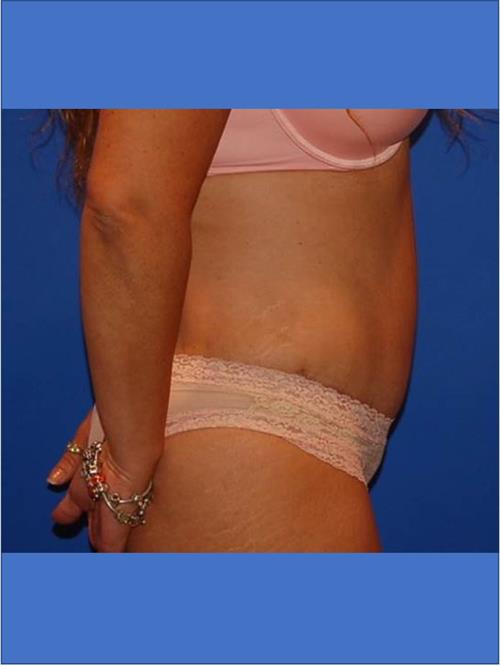 Tummy Tuck After Photo | Phoenix and Scottsdale, AZ | Scottsdale Center for Plastic Surgery