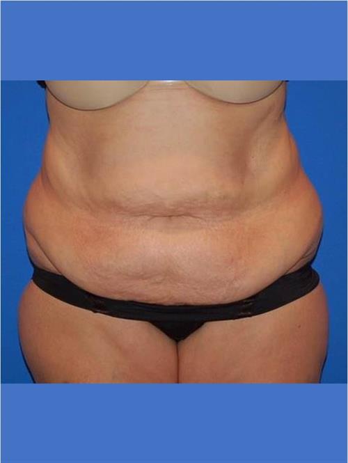 Tummy Tuck Before Photo | Phoenix and Scottsdale, AZ | Scottsdale Center for Plastic Surgery