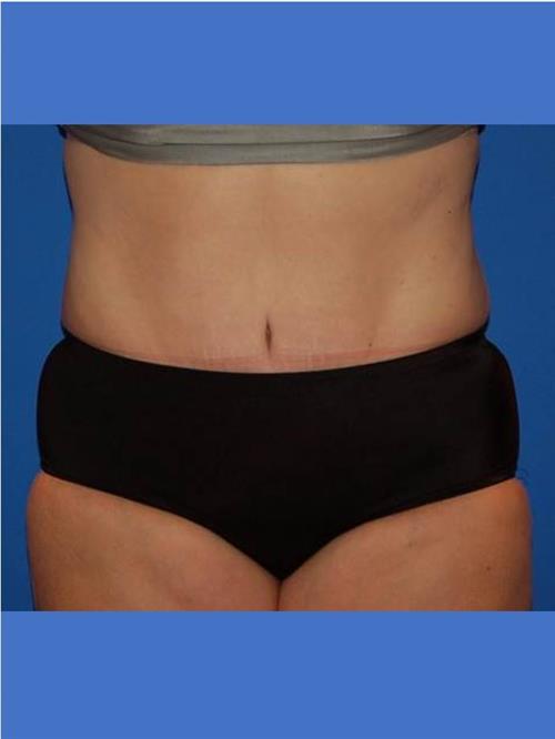 Tummy Tuck After Photo | Phoenix and Scottsdale, AZ | Scottsdale Center for Plastic Surgery