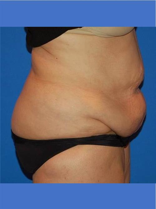 Tummy Tuck Before Photo | Phoenix and Scottsdale, AZ | Scottsdale Center for Plastic Surgery