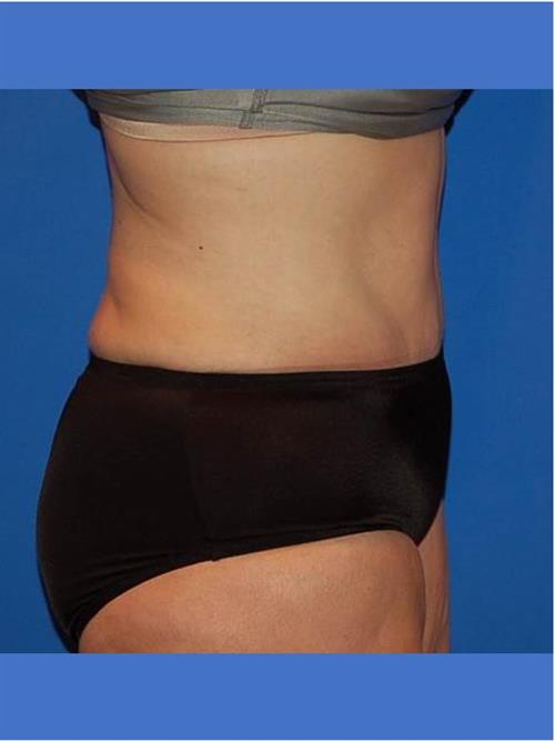Tummy Tuck After Photo | Phoenix and Scottsdale, AZ | Scottsdale Center for Plastic Surgery