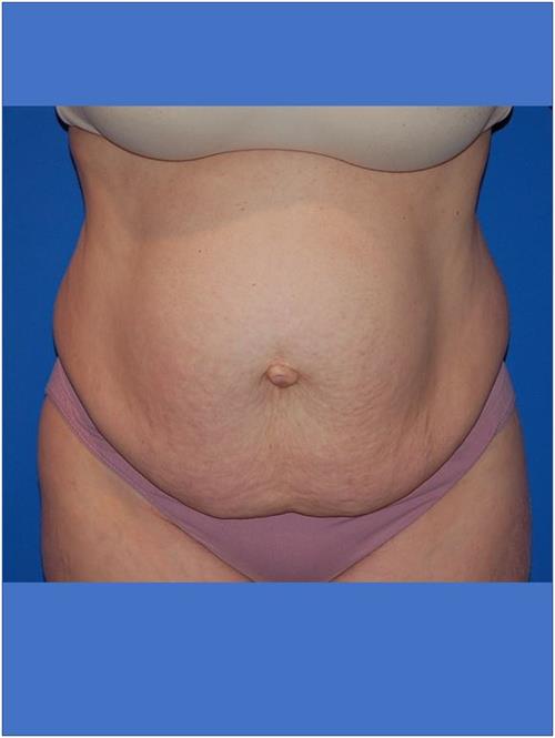 Tummy Tuck Before Photo | Phoenix and Scottsdale, AZ | Scottsdale Center for Plastic Surgery
