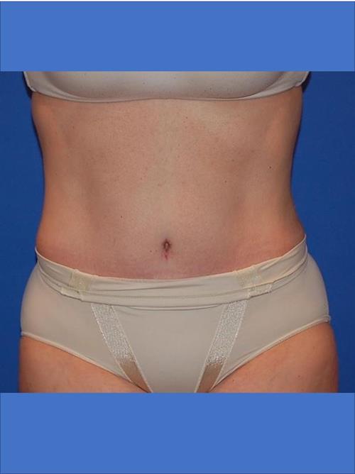 Tummy Tuck After Photo | Phoenix and Scottsdale, AZ | Scottsdale Center for Plastic Surgery