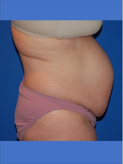 Tummy Tuck Before Photo | Phoenix and Scottsdale, AZ | Scottsdale Center for Plastic Surgery