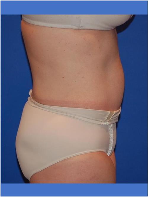 Tummy Tuck After Photo | Phoenix and Scottsdale, AZ | Scottsdale Center for Plastic Surgery