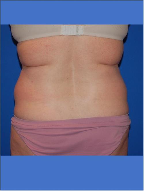Tummy Tuck Before Photo | Phoenix and Scottsdale, AZ | Scottsdale Center for Plastic Surgery