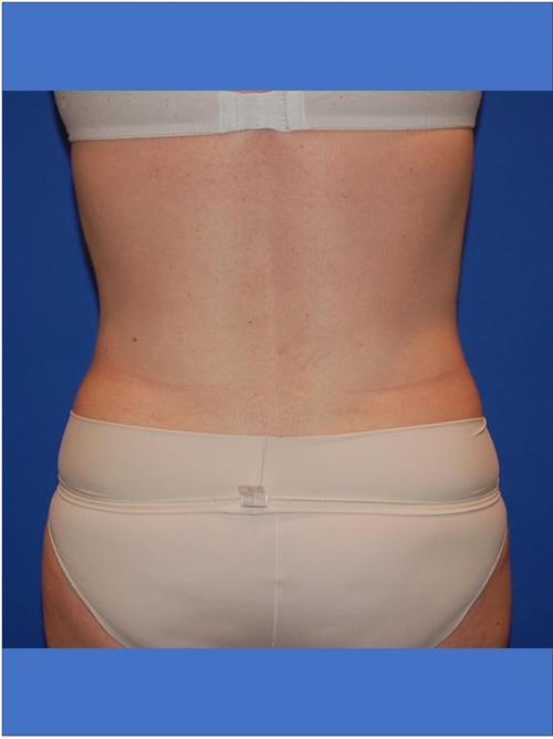 Tummy Tuck After Photo | Phoenix and Scottsdale, AZ | Scottsdale Center for Plastic Surgery