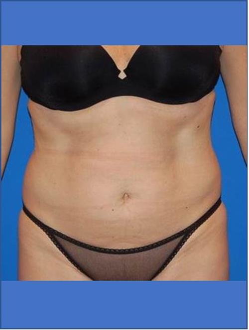 Tummy Tuck Before Photo | Phoenix and Scottsdale, AZ | Scottsdale Center for Plastic Surgery