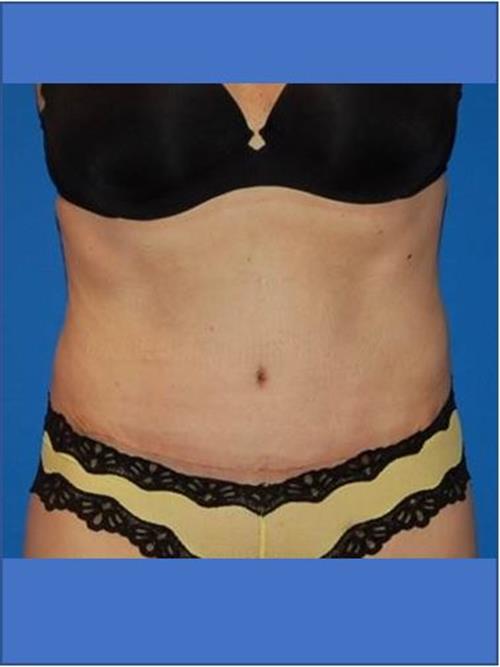 Tummy Tuck After Photo | Phoenix and Scottsdale, AZ | Scottsdale Center for Plastic Surgery