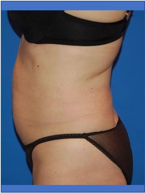 Tummy Tuck Before Photo | Phoenix and Scottsdale, AZ | Scottsdale Center for Plastic Surgery