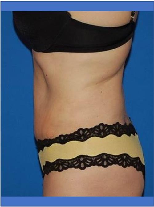 Tummy Tuck After Photo | Phoenix and Scottsdale, AZ | Scottsdale Center for Plastic Surgery