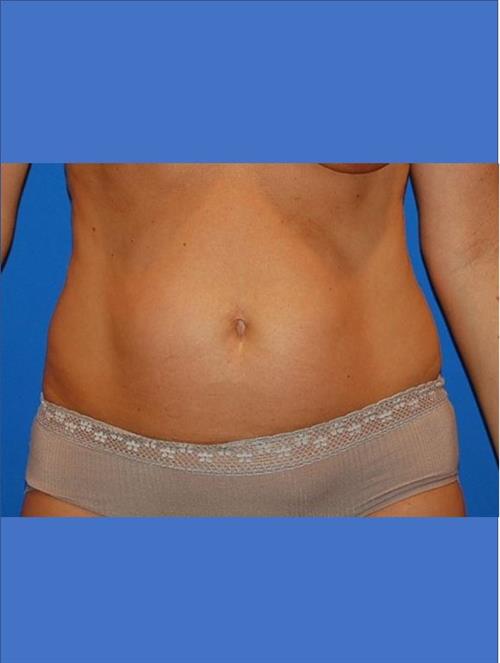 Power Assisted Liposuction Before Photo | Phoenix and Scottsdale, AZ | Scottsdale Center for Plastic Surgery