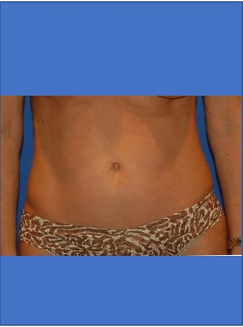 Power Assisted Liposuction After Photo | Phoenix and Scottsdale, AZ | Scottsdale Center for Plastic Surgery