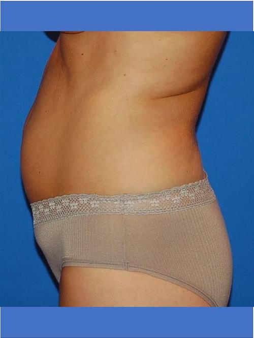 Power Assisted Liposuction Before Photo | Phoenix and Scottsdale, AZ | Scottsdale Center for Plastic Surgery