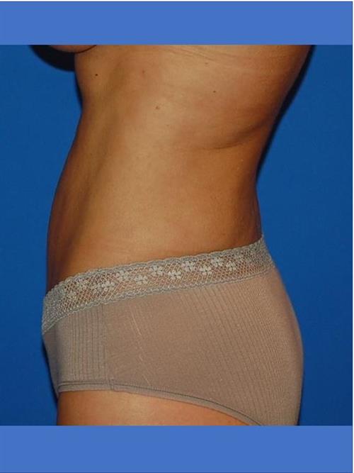 Power Assisted Liposuction After Photo | Phoenix and Scottsdale, AZ | Scottsdale Center for Plastic Surgery