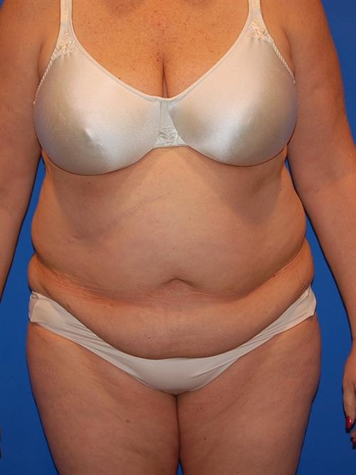 Power Assisted Liposuction Before Photo | Phoenix and Scottsdale, AZ | Scottsdale Center for Plastic Surgery
