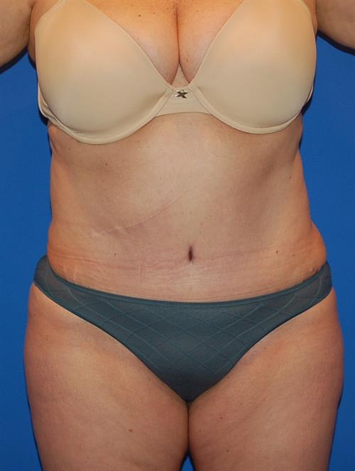 Power Assisted Liposuction After Photo | Phoenix and Scottsdale, AZ | Scottsdale Center for Plastic Surgery