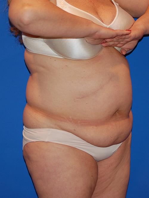 Power Assisted Liposuction Before Photo | Phoenix and Scottsdale, AZ | Scottsdale Center for Plastic Surgery