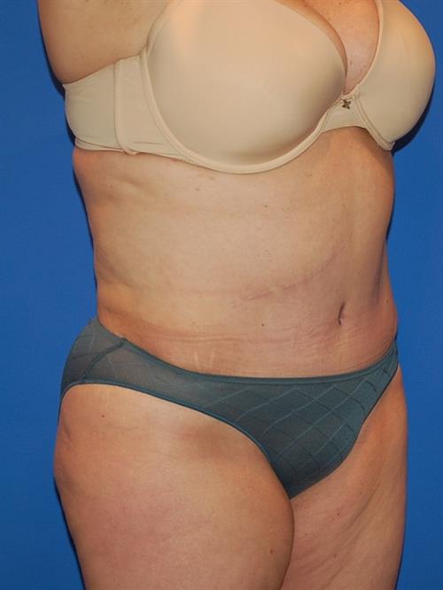 Power Assisted Liposuction After Photo | Phoenix and Scottsdale, AZ | Scottsdale Center for Plastic Surgery