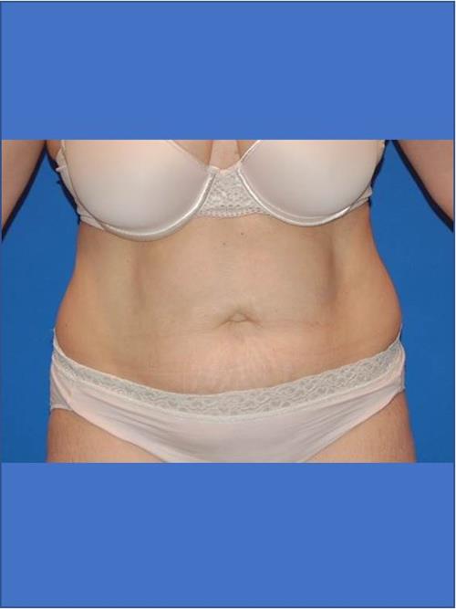 Tummy Tuck Before Photo | Phoenix and Scottsdale, AZ | Scottsdale Center for Plastic Surgery