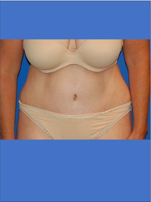 Tummy Tuck After Photo | Phoenix and Scottsdale, AZ | Scottsdale Center for Plastic Surgery