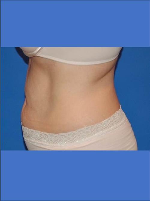 Tummy Tuck Before Photo | Phoenix and Scottsdale, AZ | Scottsdale Center for Plastic Surgery