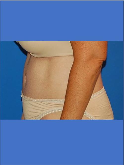 Tummy Tuck After Photo | Phoenix and Scottsdale, AZ | Scottsdale Center for Plastic Surgery