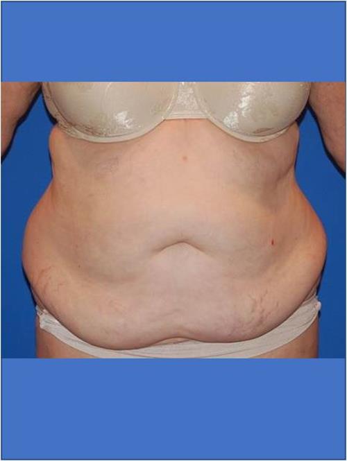 Tummy Tuck Before Photo | Phoenix and Scottsdale, AZ | Scottsdale Center for Plastic Surgery