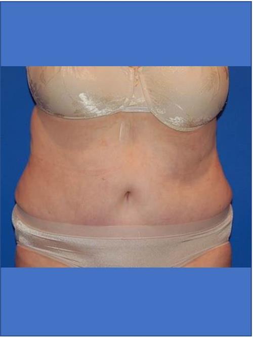 Tummy Tuck After Photo | Phoenix and Scottsdale, AZ | Scottsdale Center for Plastic Surgery