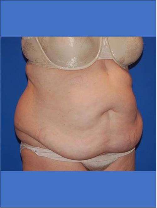 Tummy Tuck Before Photo | Phoenix and Scottsdale, AZ | Scottsdale Center for Plastic Surgery