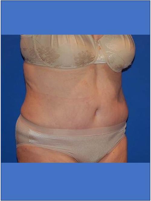 Tummy Tuck After Photo | Phoenix and Scottsdale, AZ | Scottsdale Center for Plastic Surgery