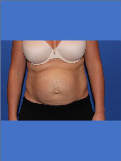 Tummy Tuck Before Photo | Phoenix and Scottsdale, AZ | Scottsdale Center for Plastic Surgery