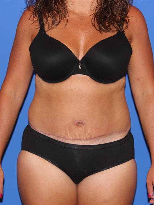 Tummy Tuck After Photo | Phoenix and Scottsdale, AZ | Scottsdale Center for Plastic Surgery