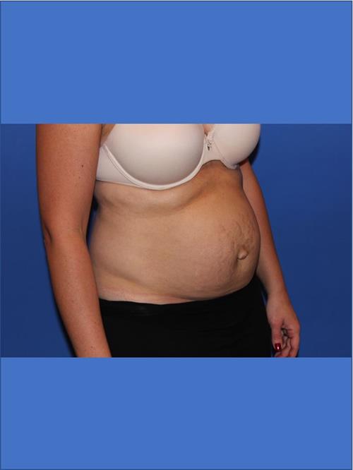 Tummy Tuck Before Photo | Phoenix and Scottsdale, AZ | Scottsdale Center for Plastic Surgery