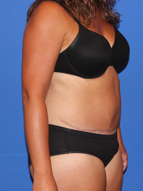Tummy Tuck After Photo | Phoenix and Scottsdale, AZ | Scottsdale Center for Plastic Surgery