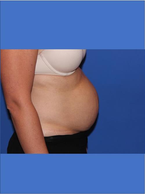 Tummy Tuck Before Photo | Phoenix and Scottsdale, AZ | Scottsdale Center for Plastic Surgery