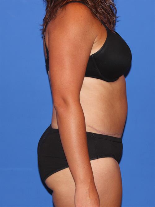 Tummy Tuck After Photo | Phoenix and Scottsdale, AZ | Scottsdale Center for Plastic Surgery