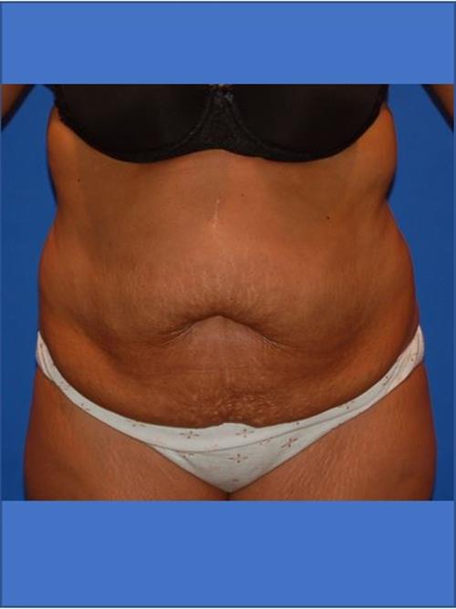 Tummy Tuck Before Photo | Phoenix and Scottsdale, AZ | Scottsdale Center for Plastic Surgery