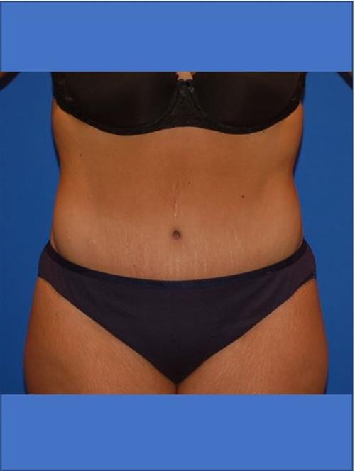 Tummy Tuck After Photo | Phoenix and Scottsdale, AZ | Scottsdale Center for Plastic Surgery