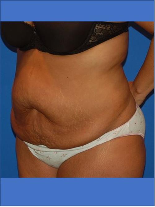 Tummy Tuck Before Photo | Phoenix and Scottsdale, AZ | Scottsdale Center for Plastic Surgery