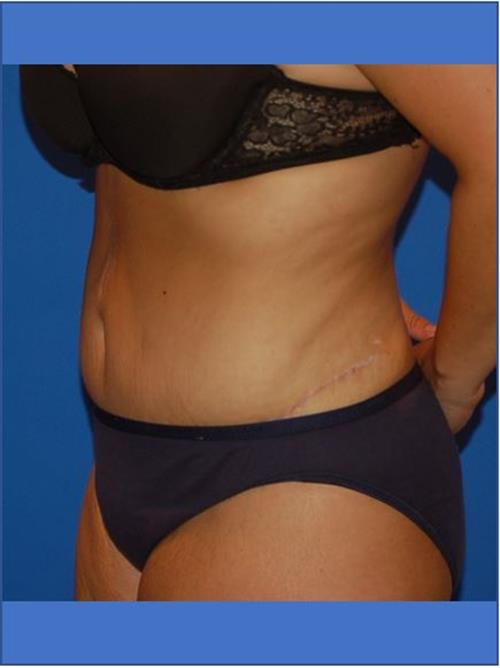 Tummy Tuck After Photo | Phoenix and Scottsdale, AZ | Scottsdale Center for Plastic Surgery